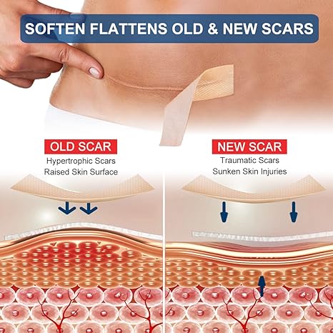 Silicone Scar Sheets (1.6” x 120” Roll-3M), Silicone Scar Tape Roll, Scar Silicone Strips, Reusable, Professional Scar Removal Sheets for C-Section, Surgery, Burn, Keloid, Acne et - Image 7