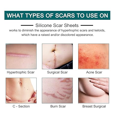 Silicone Scar Sheets (1.6” x 120” Roll-3M), Silicone Scar Tape Roll, Scar Silicone Strips, Reusable, Professional Scar Removal Sheets for C-Section, Surgery, Burn, Keloid, Acne et - Image 3