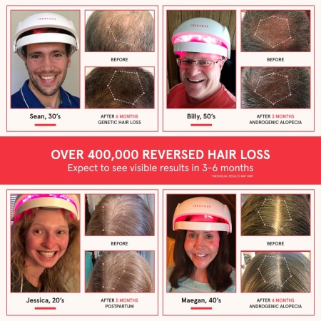 iRestore Laser Hair Growth Device