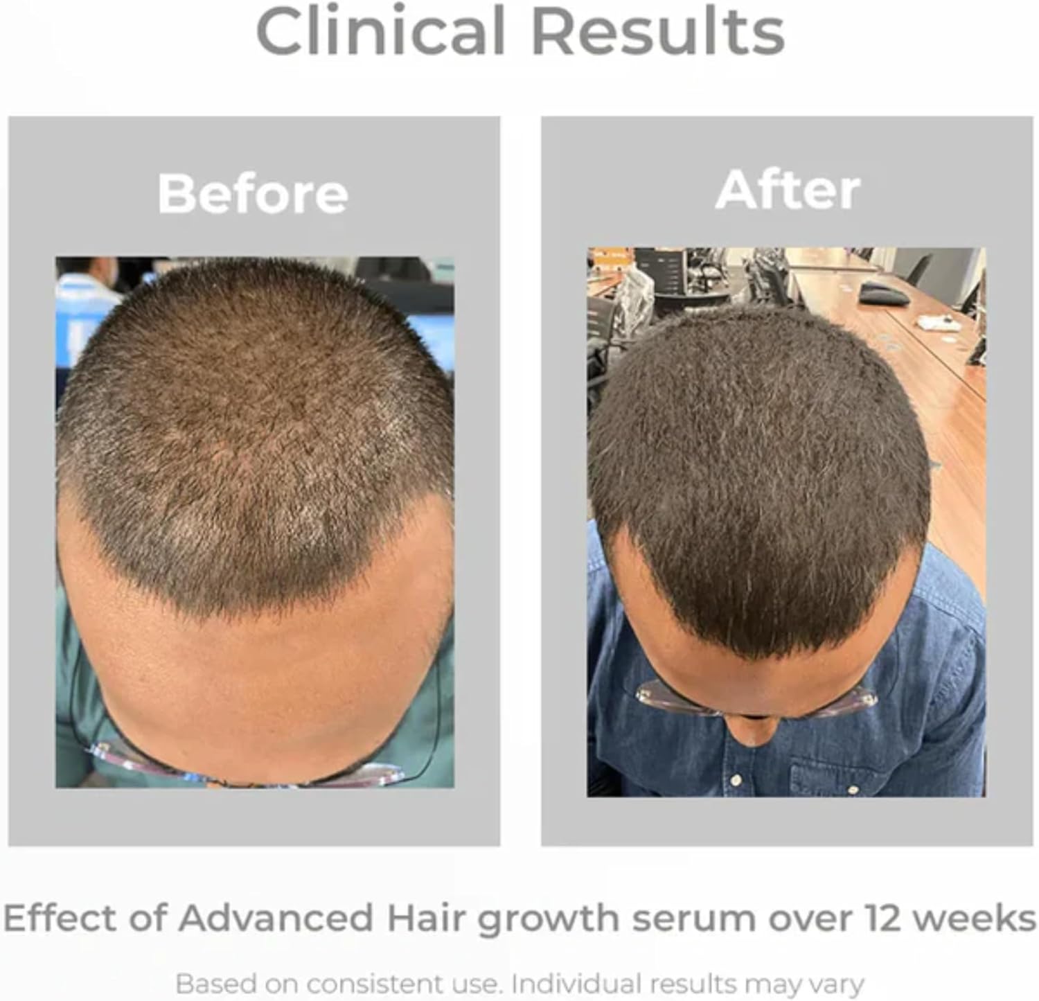 Pilgrim Hair Growth Serum | Redensyl & Anagain | Stops Hair Loss - Image 8
